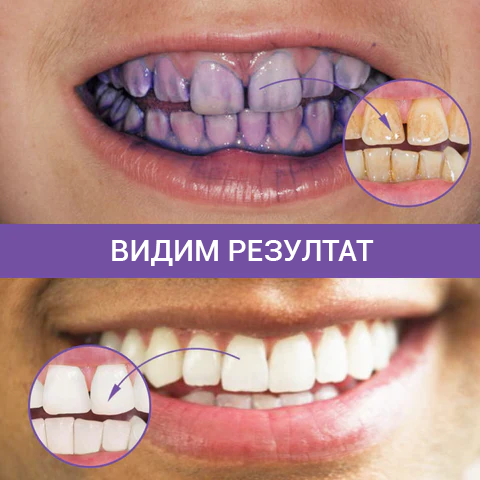 🦷Коректор на цвета на зъбите и серум за грижа за емайла