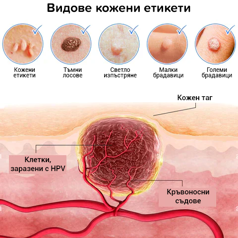 2023 Premium Кремове за кожни петна, бенки и брадавици!!!