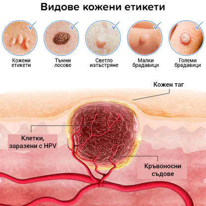 2024 Premium Кремове за кожни петна, бенки и брадавици!!!!